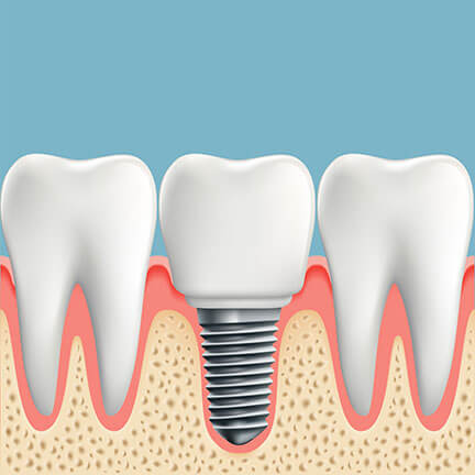 Dental implants | King Dental | Illustration of a dental implant
