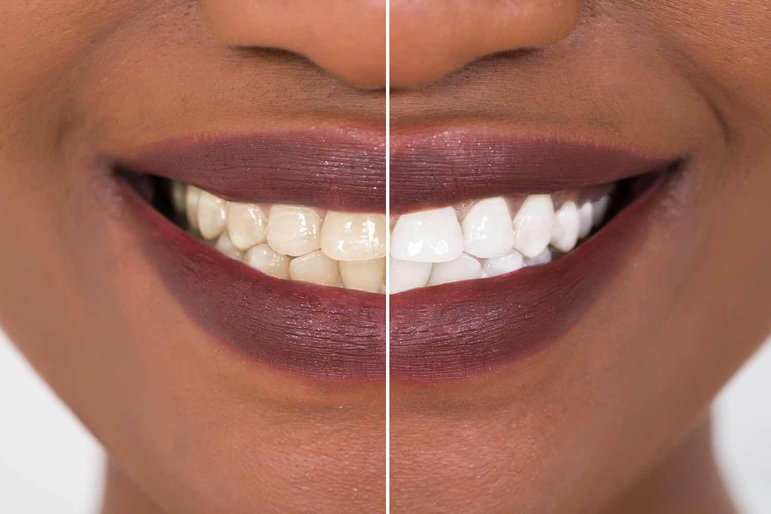 Get teeth whitening at King Dental in Bronzeville
