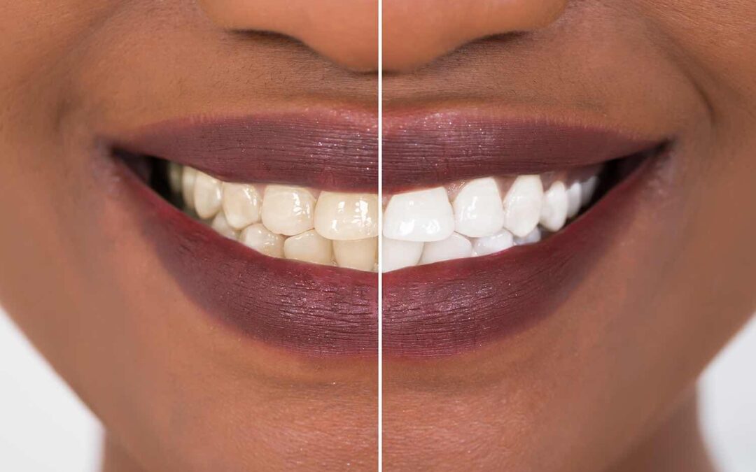 Teeth Whitening - King Dental in Bronzeville